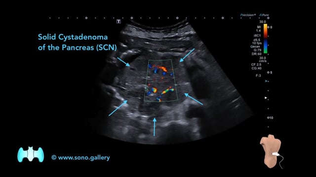 Solid Cystadenoma of the Pancreas (SCN)