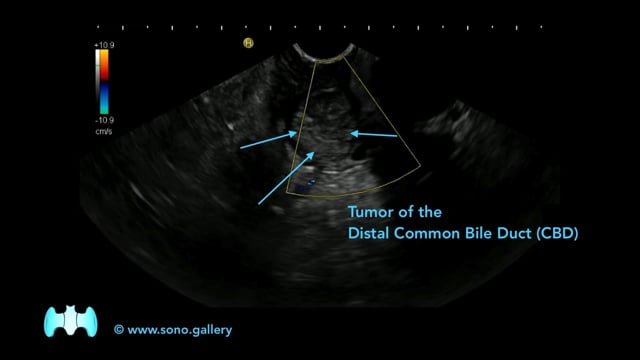 Tumor of the Distal Common Bile Duct (CBD)