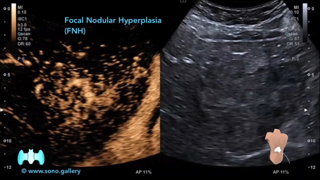 Focal Nodular Hyperplasia (FNH)