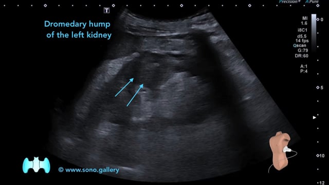 Dromedary hump of the left kidney