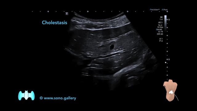 Cholestasis