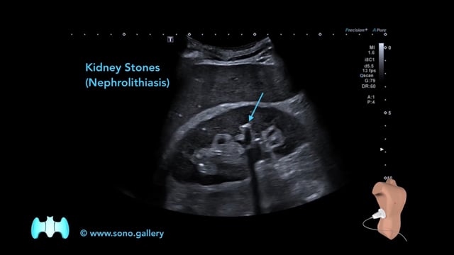 Kidney Stones (Nephrolithiasis)