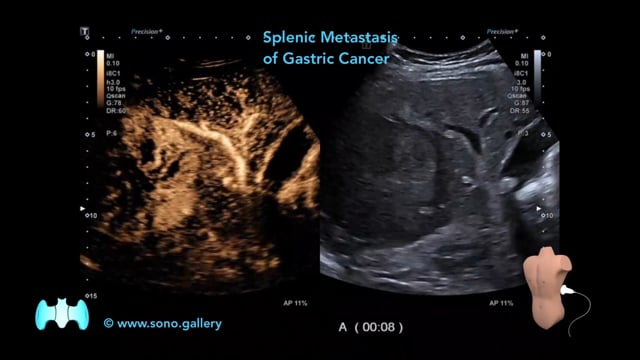 Splenic Metastasis of Gastric Cancer