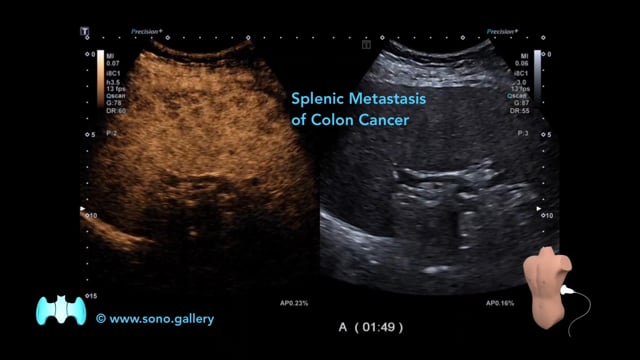Splenic Metastasis of Colon Cancer
