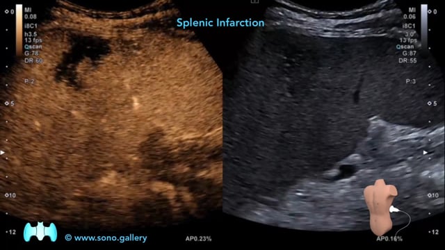 Splenic Infarction