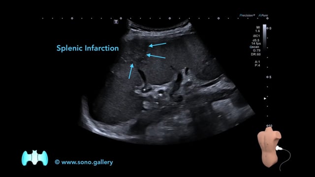 Splenic Infarction