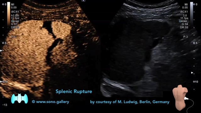 Splenic Rupture