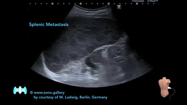 Splenic Metastasis