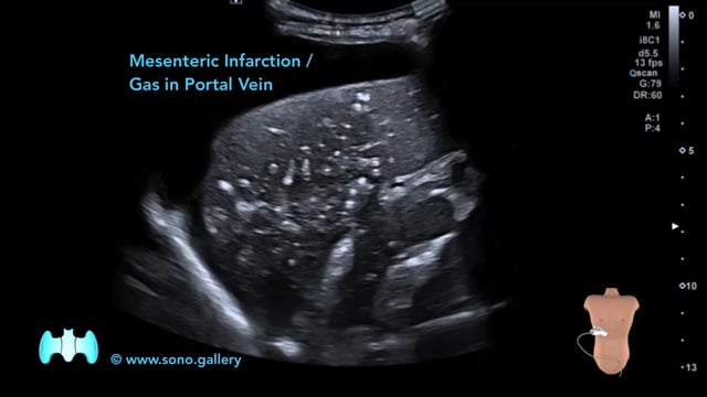 Mesenteric Infarction / Gas in Portal Vein
