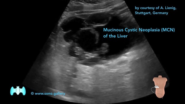 Mucinous Cystic Neoplasia (MCN) of the Liver