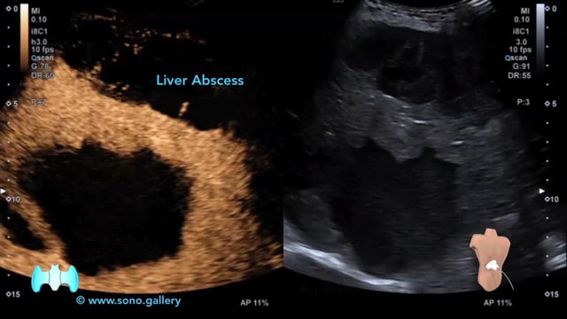 Liver Abscess