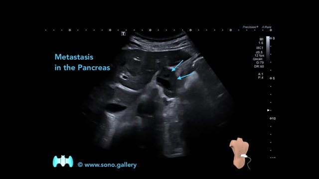 Metastasis in the Pancreas