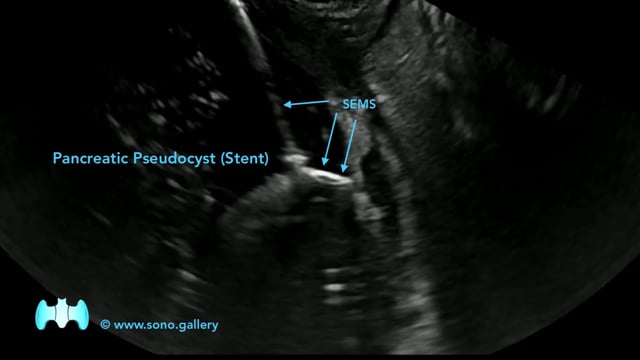 Pancreatic Pseudocyst (Stent) - SONO.GALLERY