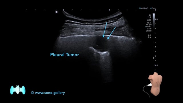 Pleural Tumor