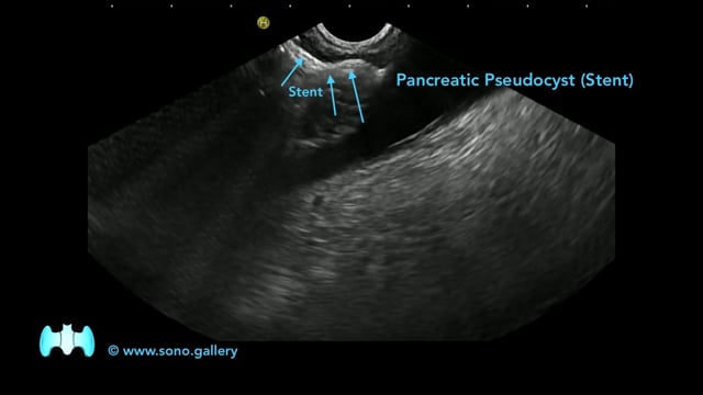 Pancreatic Pseudocyst (Stent)