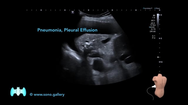 Pneumonia, Pleural Effusion