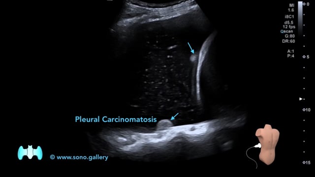 Pleural Carcinomatosis