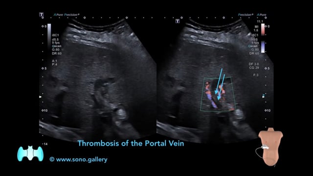 Thrombosis of the Portal Vein