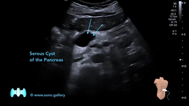 Serous Cyst of the Pancreas