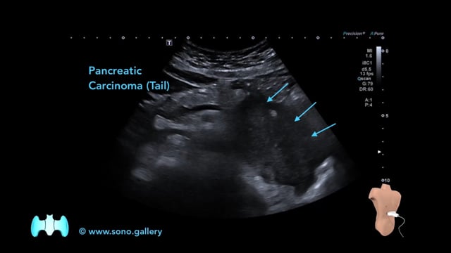 Pancreatic Carcinoma (Tail)