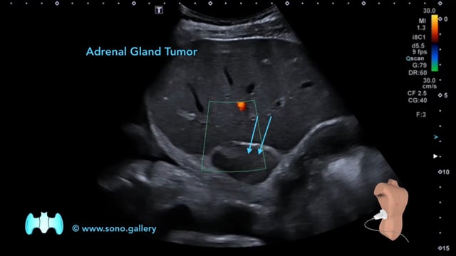 Adrenal Gland Tumor