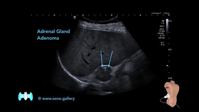 Adrenal Gland Adenoma