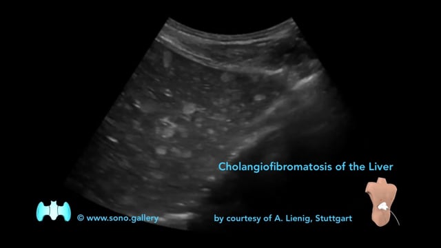 Cholangiofibromatosis of the Liver