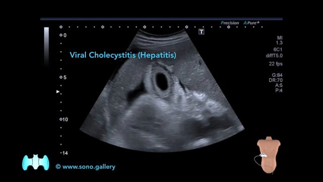 Viral Cholecystitis (Hepatitis)