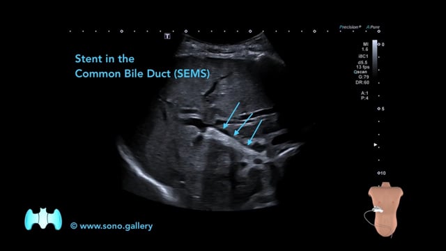 Stent in the Common Bile Duct (SEMS)