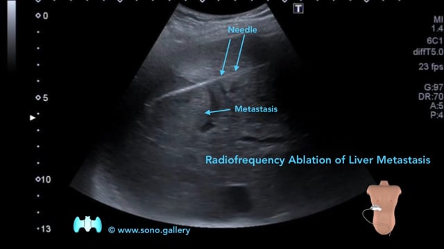 Radiofrequency Ablation of Liver Metastasis