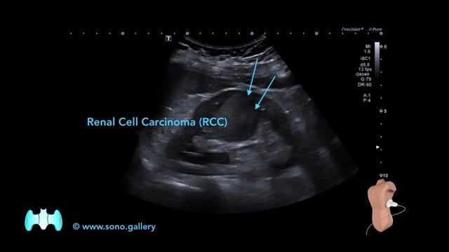 Renal Cell Carcinoma (RCC)