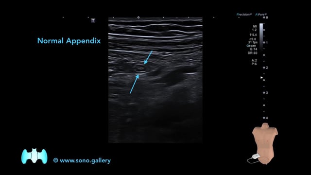 Normal Appendix