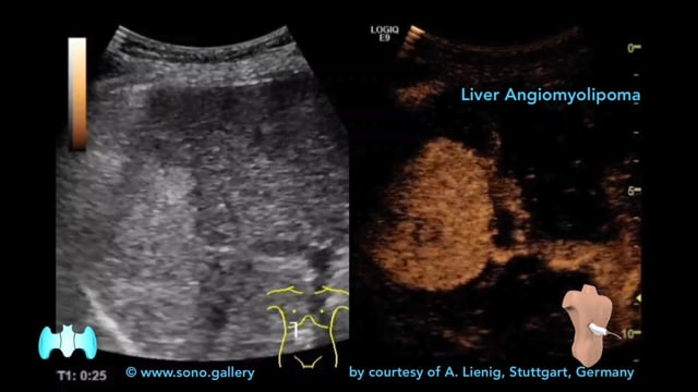 Liver Angiomyolipoma