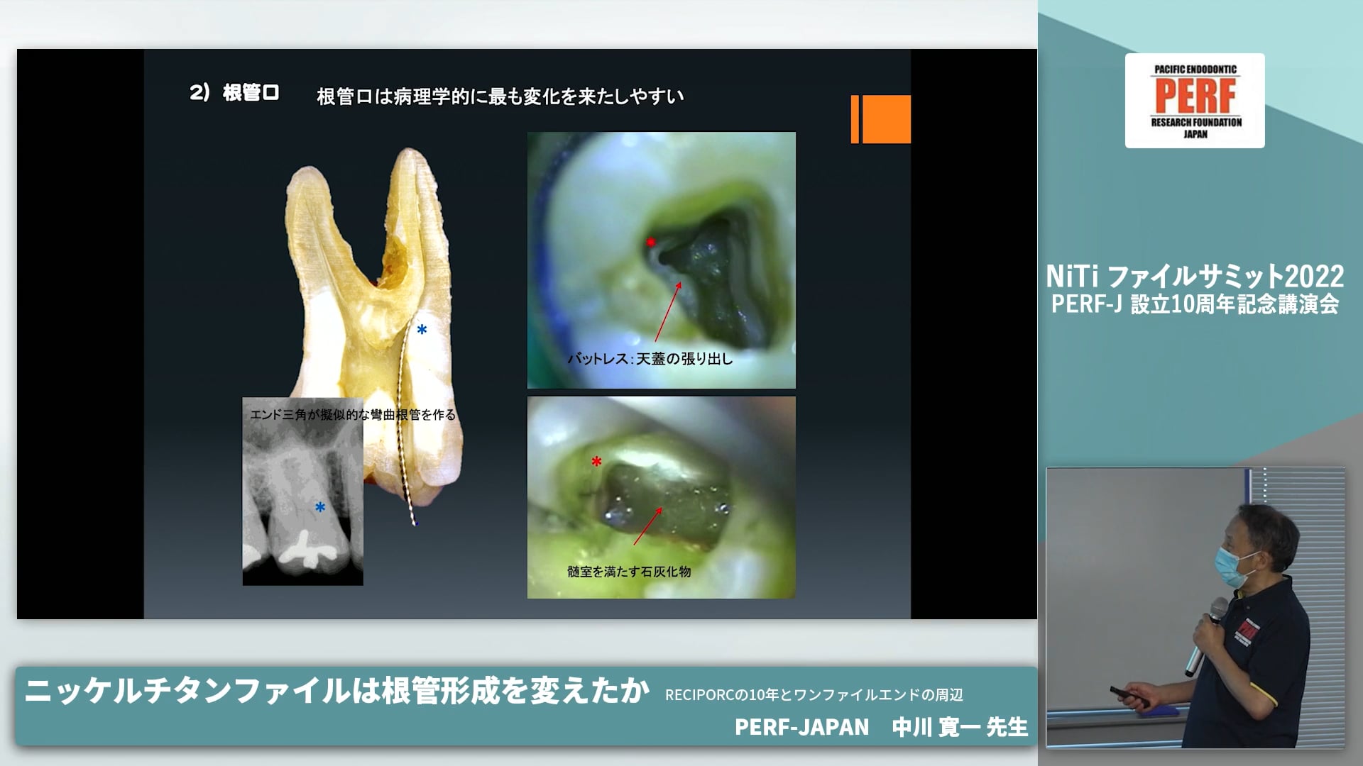 ニッケルチタンファイルは根管形成を変えたか RECIPORC の10年とワンファイルエンド│中川寛一先生