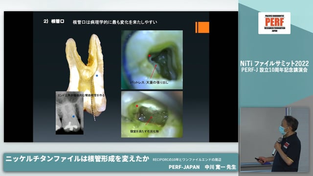 ニッケルチタンファイルは根管形成を変えたか RECIPORC の10年とワンファイルエンド│中川寛一先生