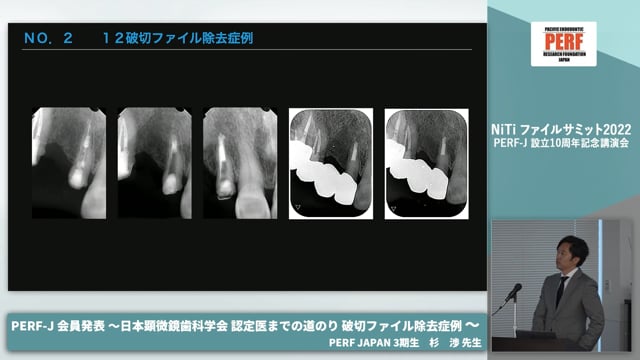 破切ファイル除去症例 日本顕微鏡歯科学会認定医までの道のり│杉渉先生