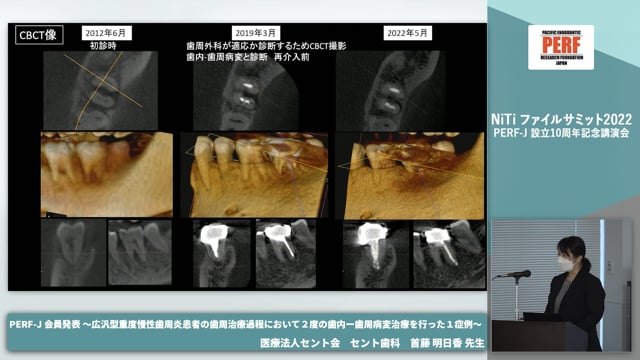 広汎型重度慢性歯周炎患者の歯周治療過程において ２度の歯内-歯周病変治療を行った１症例│首藤明日香先生