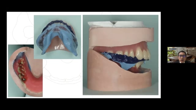 ニュートラルゾーンを意識した義歯製作〜フレンジテクニックとピエゾグラフィ〜 #2