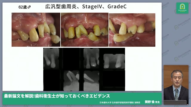 歯周炎の基礎知識、診断から治療までの流れ #1