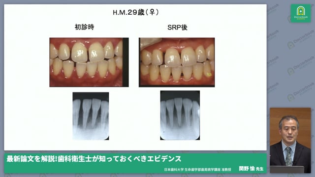 論文エビデンスに基づき非外科的歯周治療（原因除去療法）を理解しよう #2