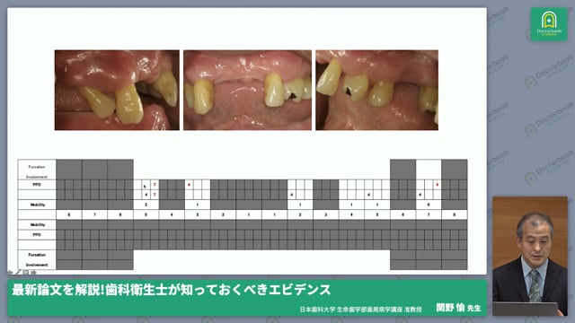 超音波スケーラー vs 手用スケーラ：信頼的なエビデンス、症例への応用 #3