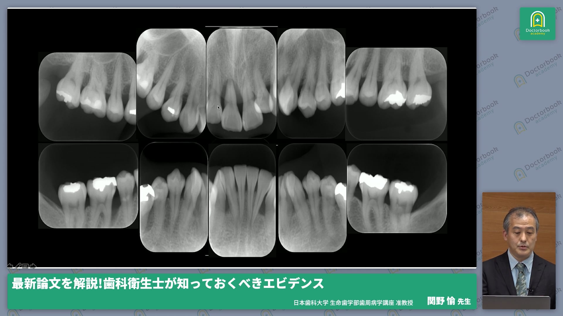 低侵襲非外科的歯周治療の最新研究結果、症例分析 #4