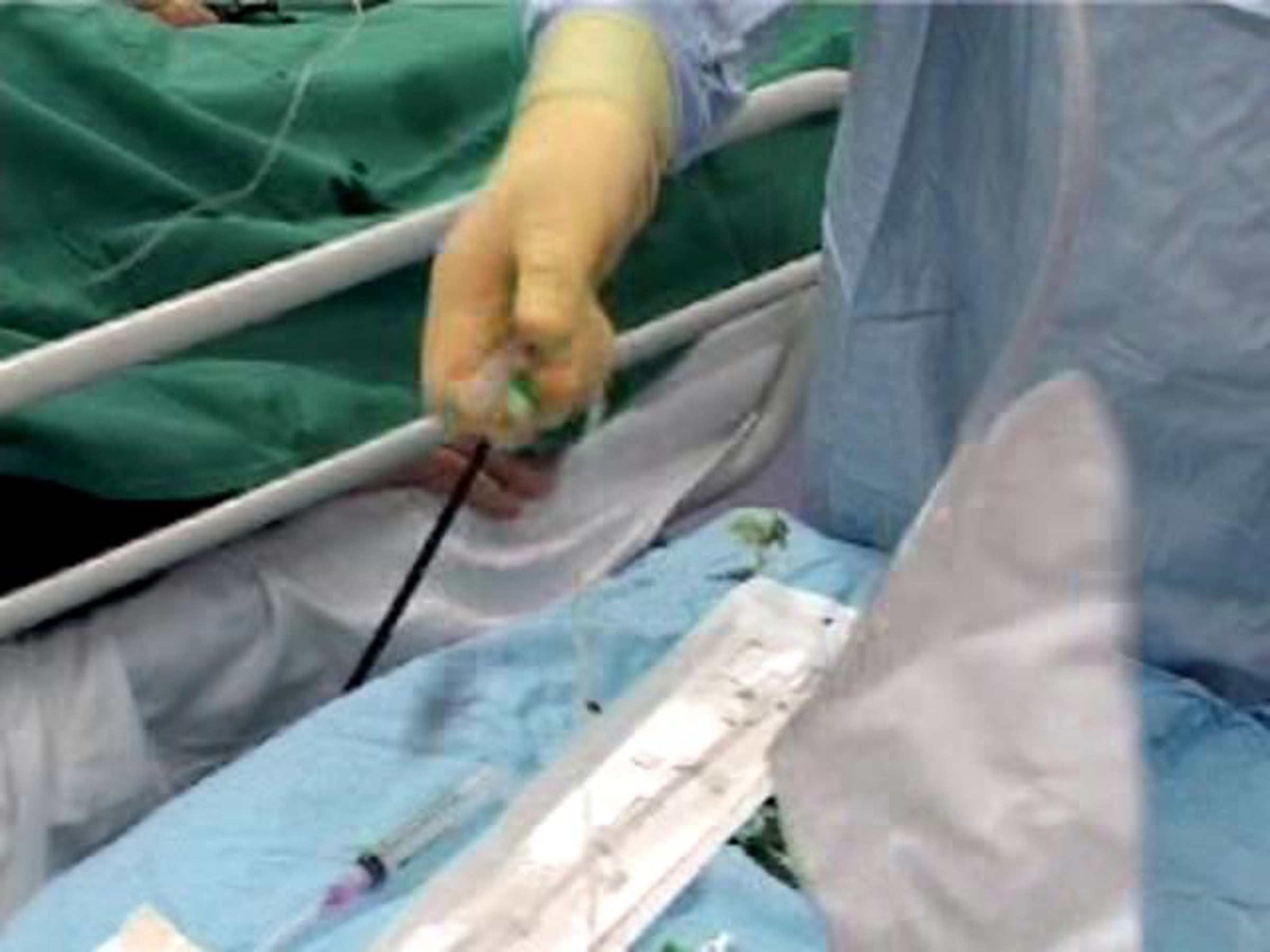 How to Insert a Foley Catheter Suprapubically