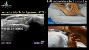 ATFL Injection Including Tibiotalar Joint Injection