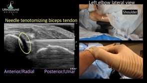 Distal Biceps Tendon Injection and Needle Tenotomy