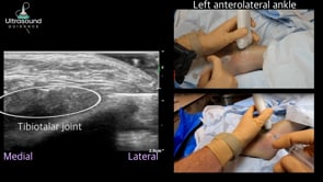 Ankle Joint Injection Lateral to Medial Approach