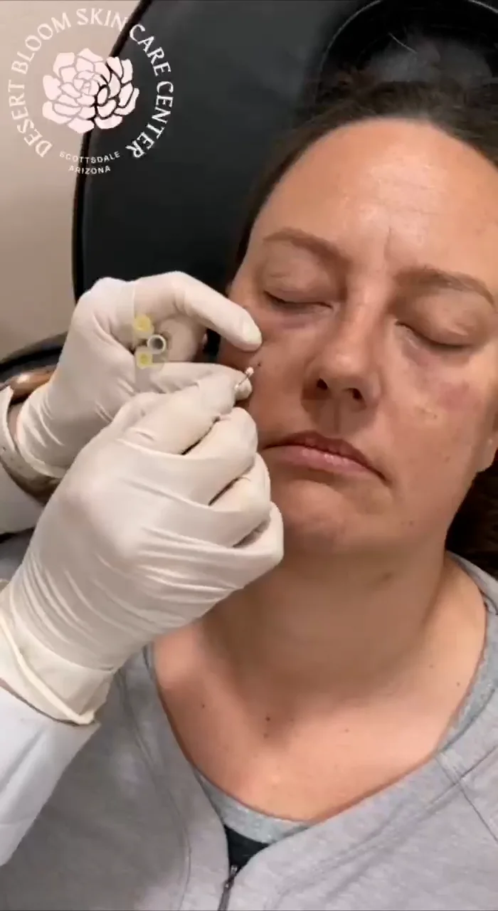 PRP tear trough correction addressing aging skin thinning, dark circles