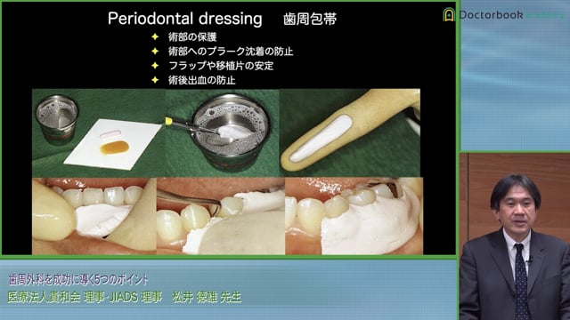 歯周外科を成功に導く５つのポイント〜基礎から臨床まで〜 