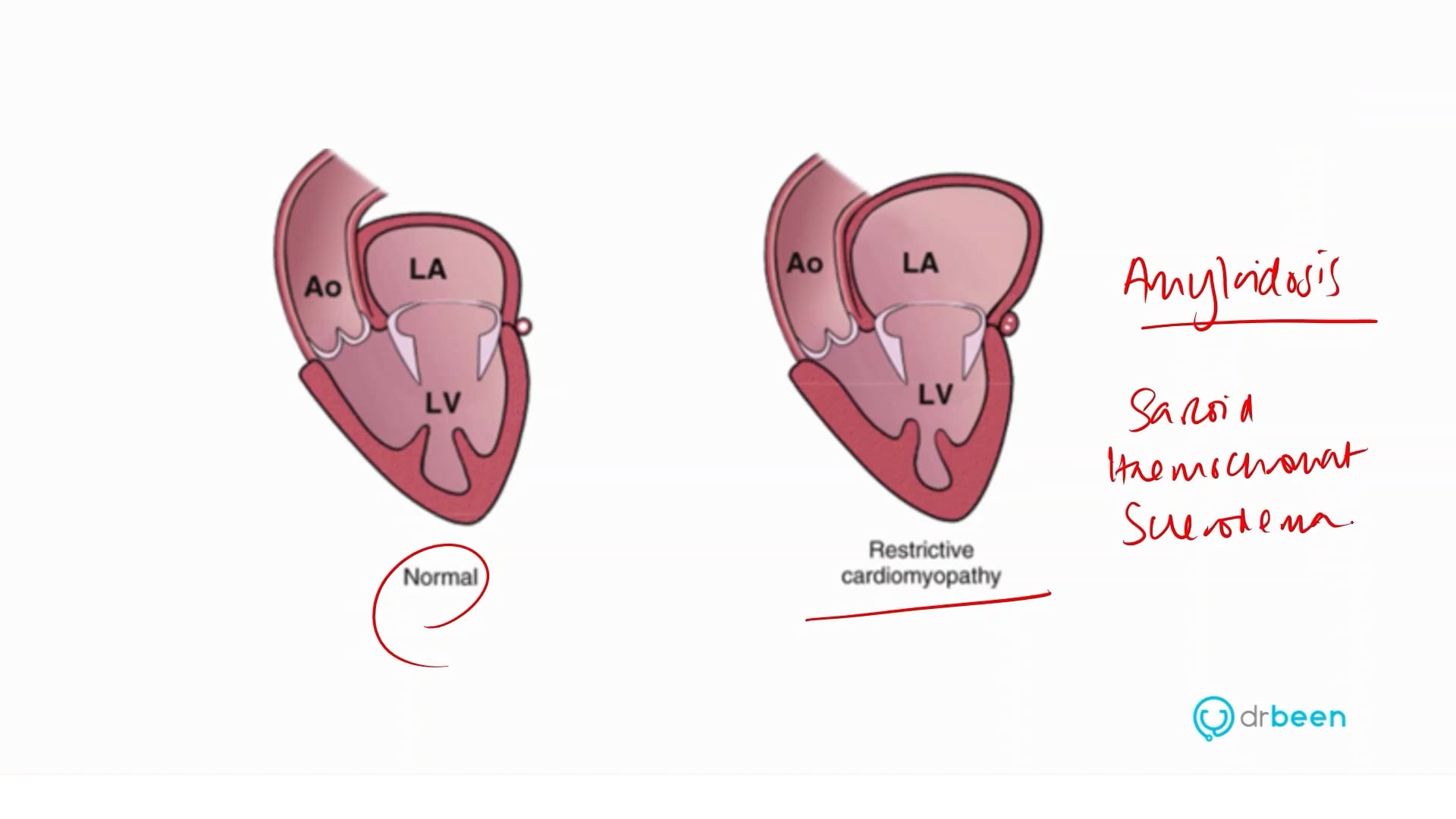 Restrictive Cardiomyopathy (Dr. Bhatti)