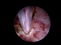 EVR nasal adenocarcinoma in dog laser debridement